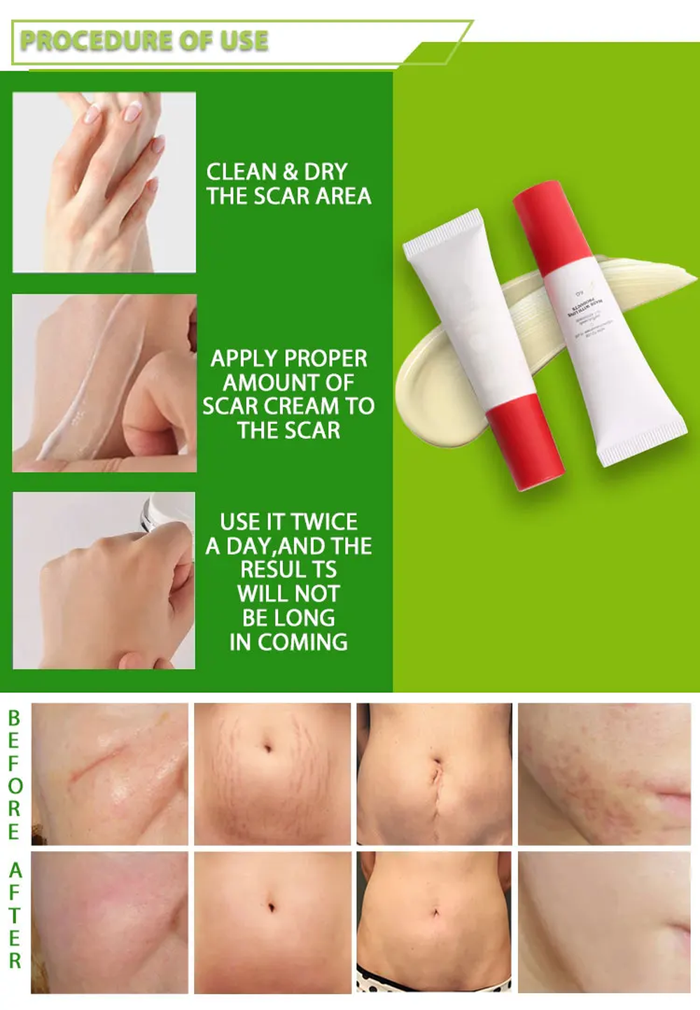 acne treatment cream acne treatment cream